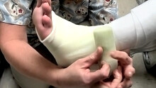 Foot Cast For Poor Evan