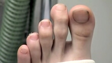 Foot Cast For Poor Evan
